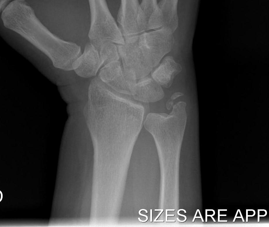 Ulna Styloid Tip Fracture